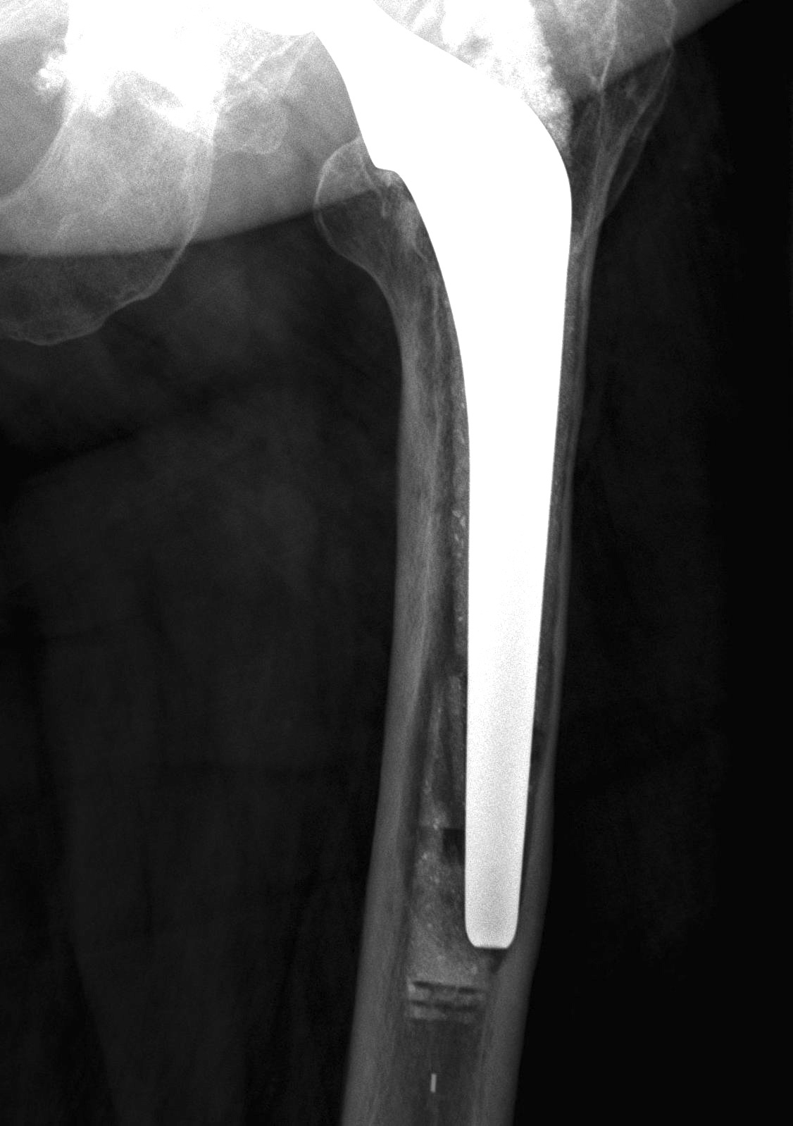 Cemented Femur Definitely Loose